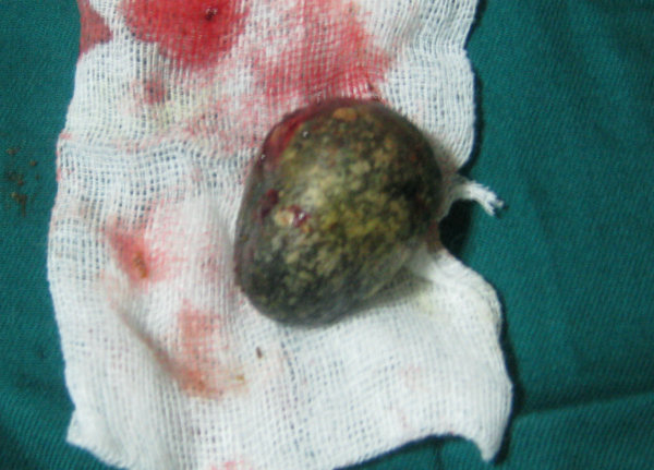取出的异物是一颗鹅卵石。术后患犬很快恢复出院。